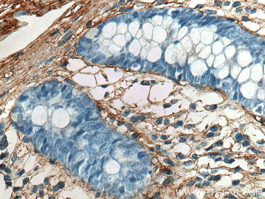 Immunohistochemistry (IHC) staining of human colon tissue using Collagen Type V Polyclonal antibody (28382-1-AP)