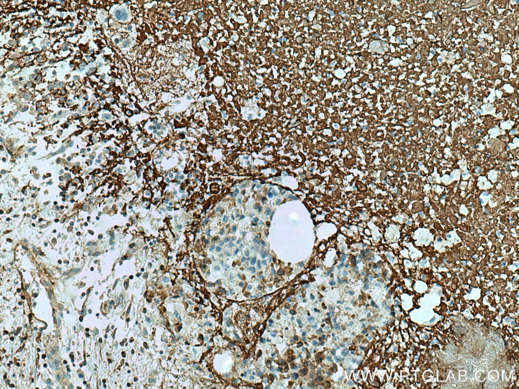 Immunohistochemistry (IHC) staining of human breast cancer tissue using Collagen Type V Monoclonal antibody (67604-1-Ig)