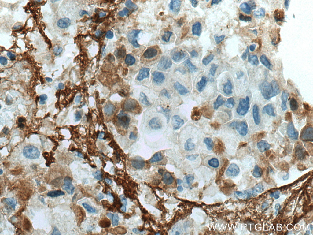 Immunohistochemistry (IHC) staining of human breast cancer tissue using Collagen Type V Monoclonal antibody (67604-1-Ig)