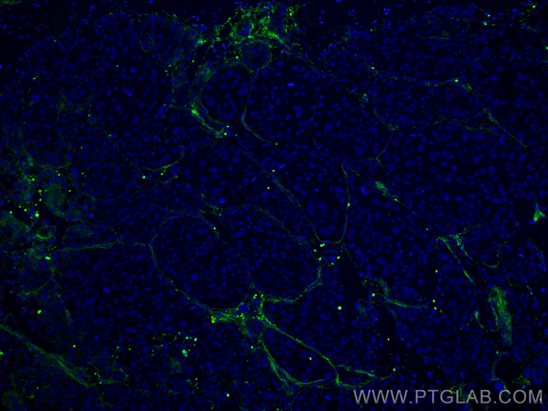 Immunofluorescence (IF) / fluorescent staining of human liver cancer tissue using CoraLite® Plus 488-conjugated Collagen Type VI  Mo (CL488-66824)