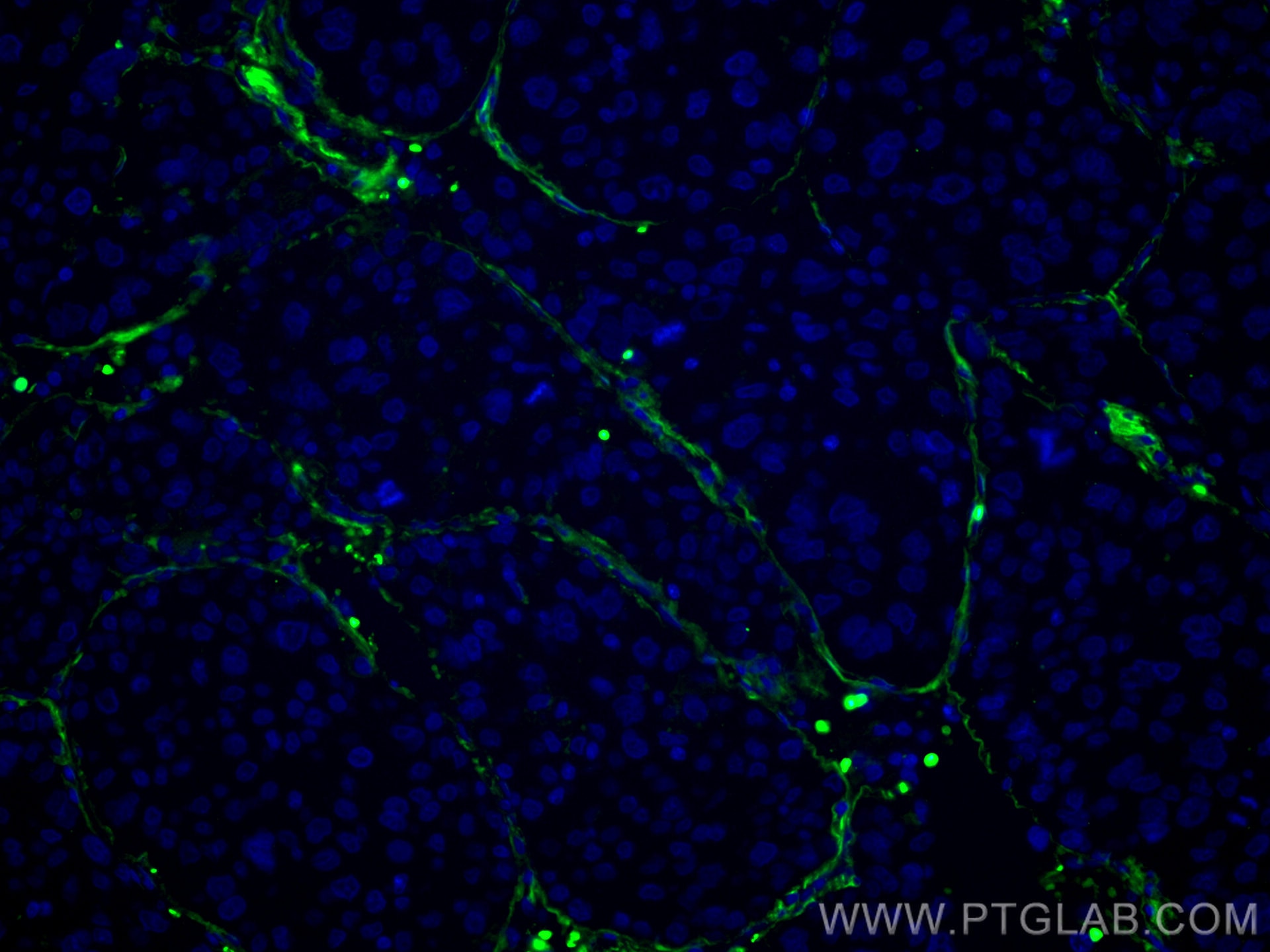 Immunofluorescence (IF) / fluorescent staining of human liver cancer tissue using CoraLite® Plus 488-conjugated Collagen Type VI  Mo (CL488-66824)