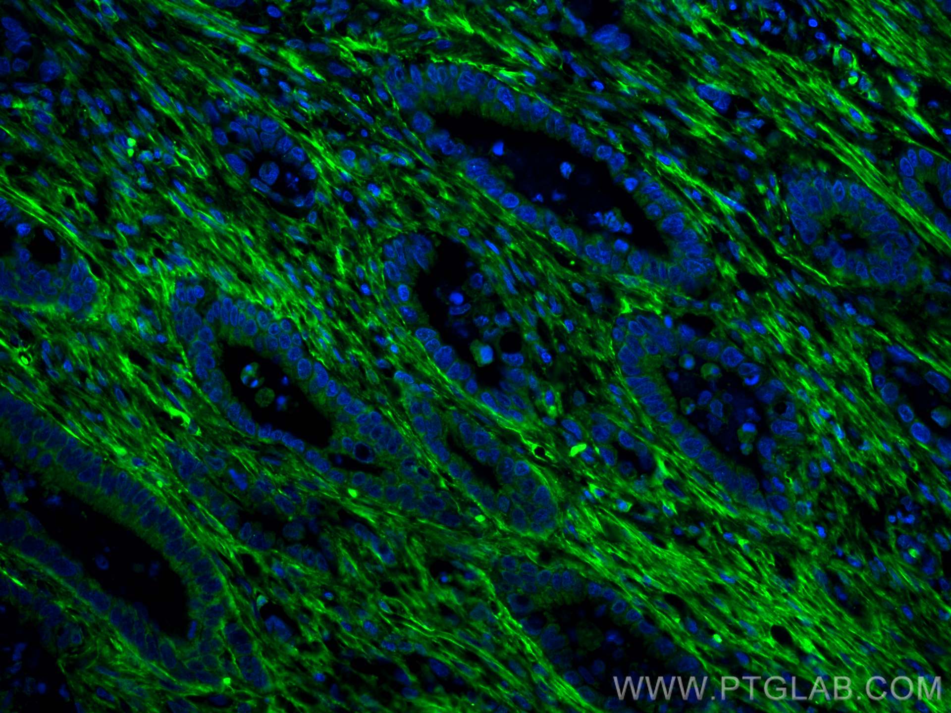 Immunofluorescence (IF) / fluorescent staining of human colon cancer tissue using CoraLite® Plus 488-conjugated Collagen Type VI  Mo (CL488-66824)