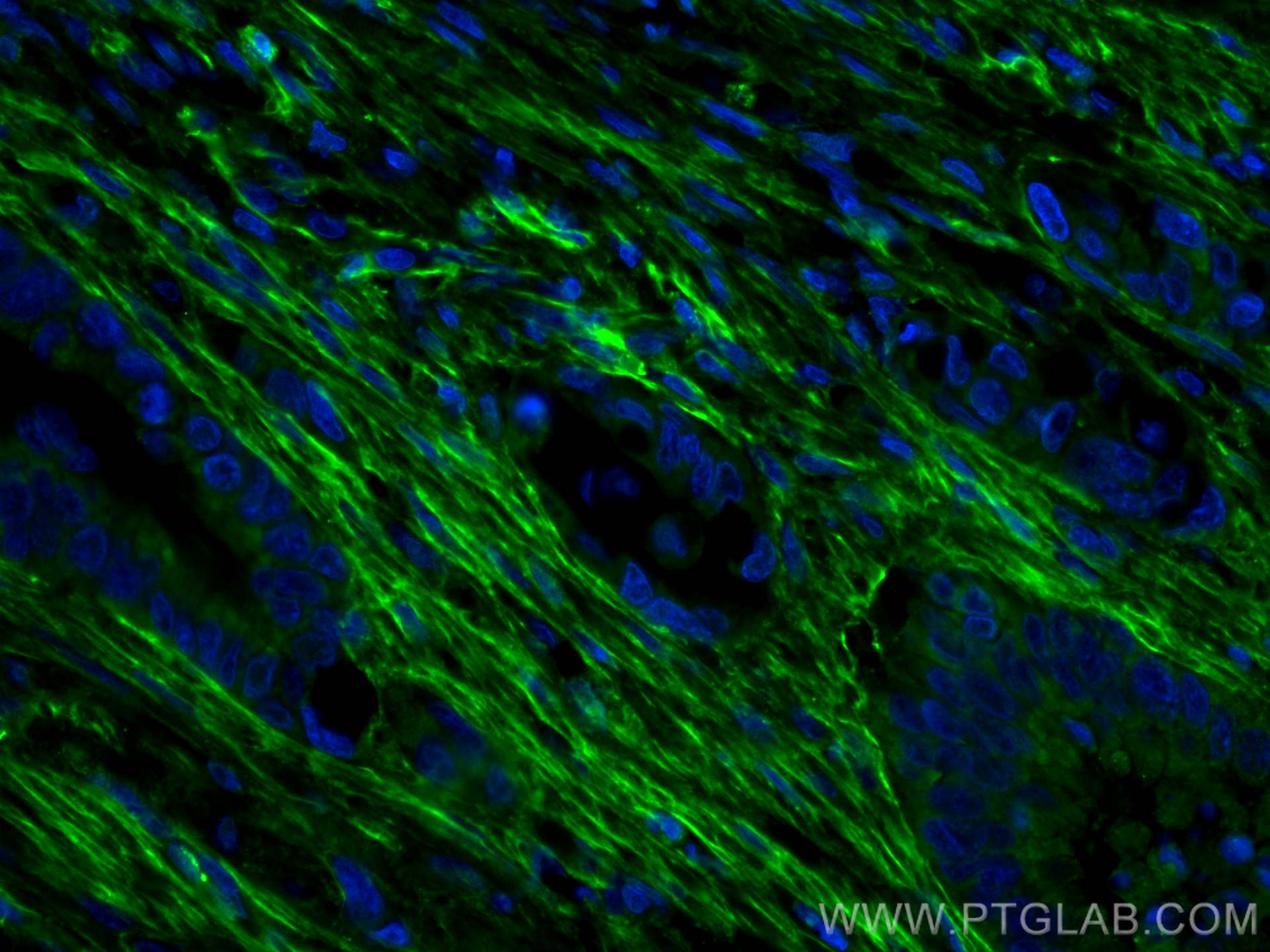 Immunofluorescence (IF) / fluorescent staining of human colon cancer tissue using CoraLite® Plus 488-conjugated Collagen Type VI  Mo (CL488-66824)