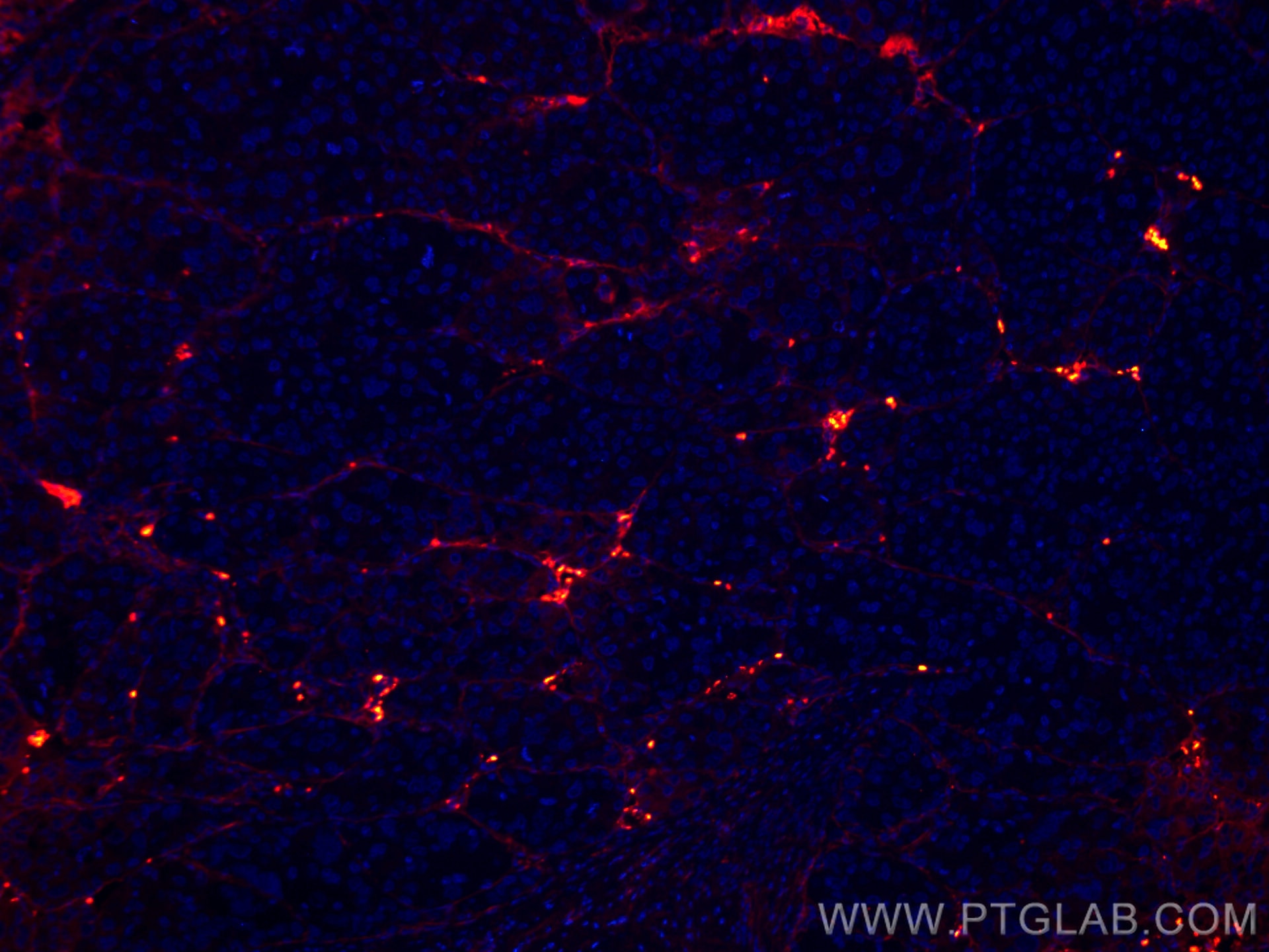 Immunofluorescence (IF) / fluorescent staining of human liver cancer tissue using CoraLite®594-conjugated Collagen Type VI  Monoclon (CL594-66824)