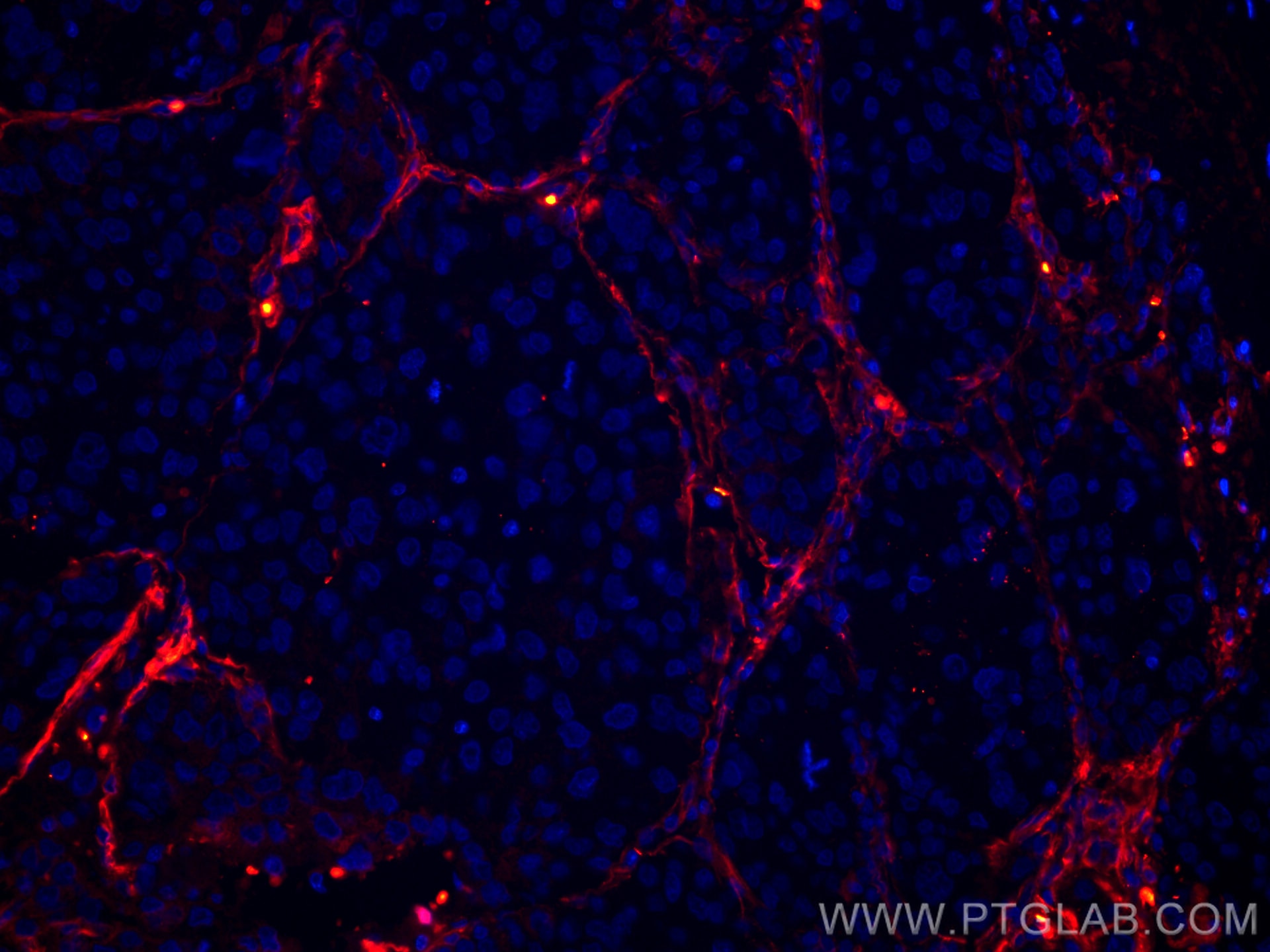 Immunofluorescence (IF) / fluorescent staining of human liver cancer tissue using CoraLite®594-conjugated Collagen Type VI  Monoclon (CL594-66824)
