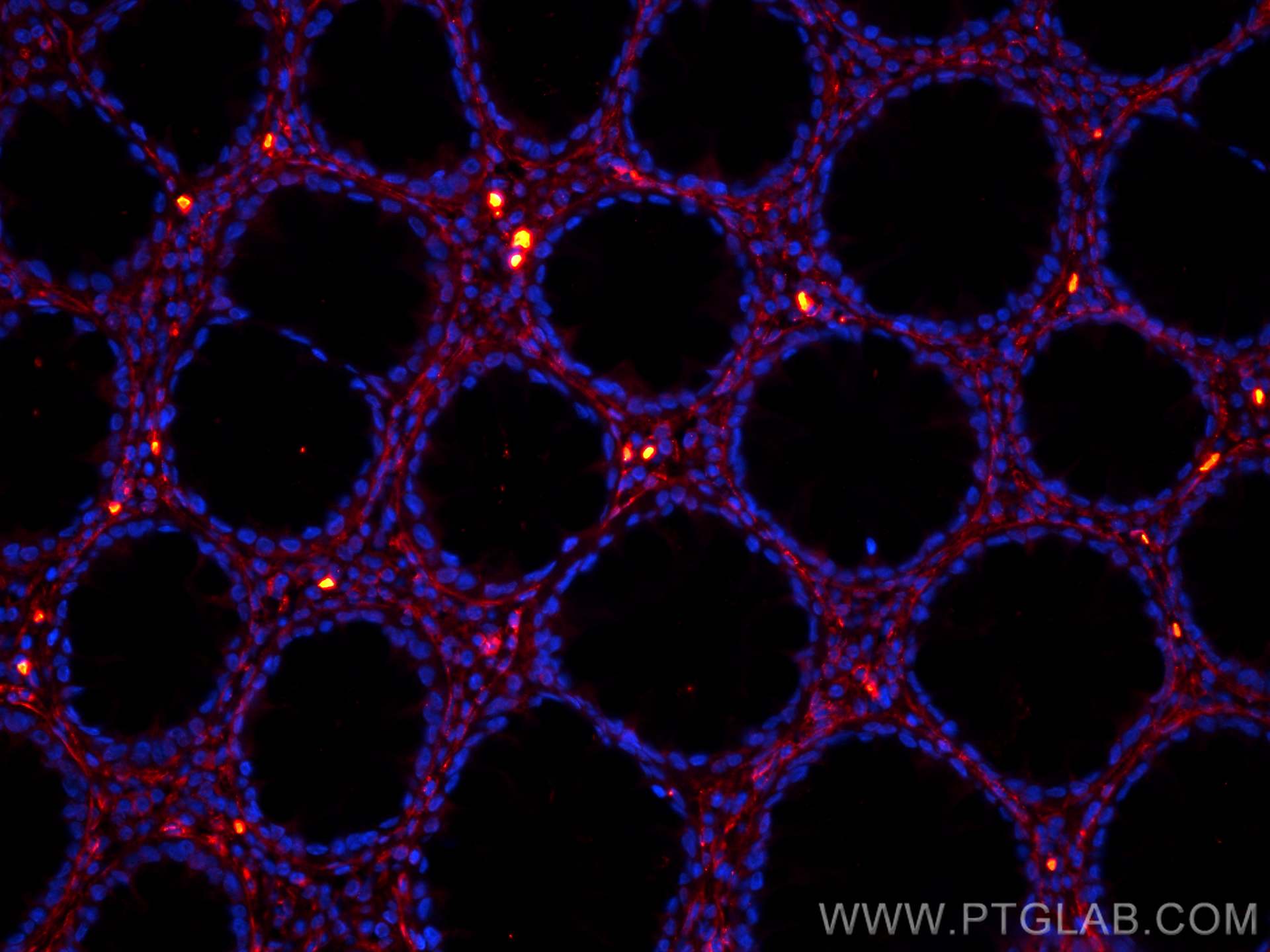 Immunofluorescence (IF) / fluorescent staining of human colon cancer tissue using CoraLite®594-conjugated Collagen Type VI  Monoclon (CL594-66824)
