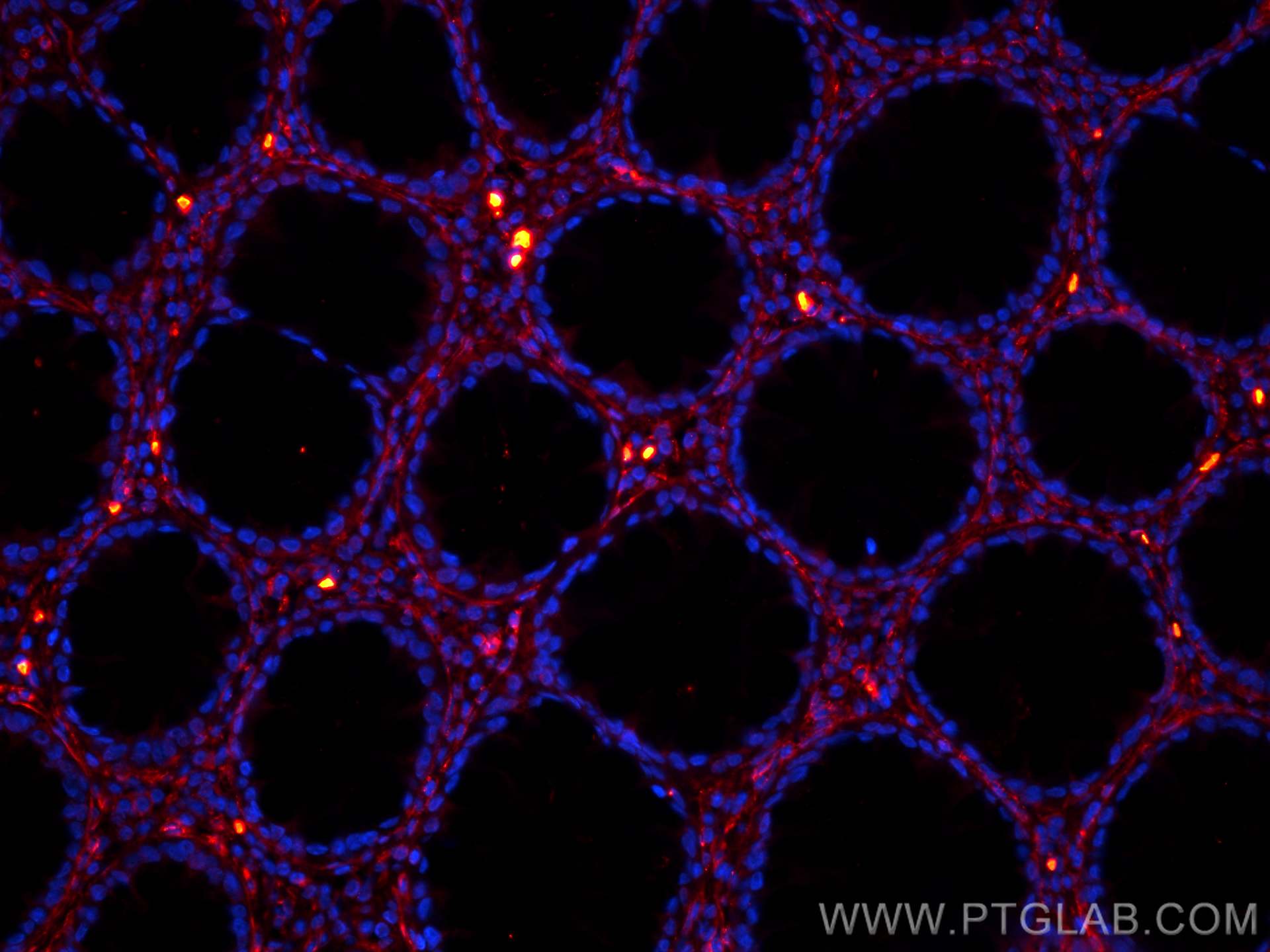 Immunofluorescence (IF) / fluorescent staining of human colon cancer tissue using CoraLite®594-conjugated COL6A1 Monoclonal antibody (CL594-66824)