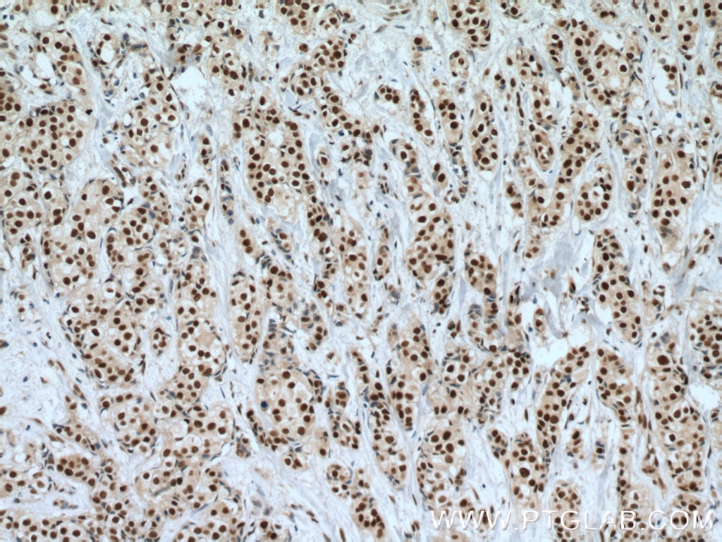 Immunohistochemistry (IHC) staining of human breast cancer tissue using CstF-64 Polyclonal antibody (26825-1-AP)