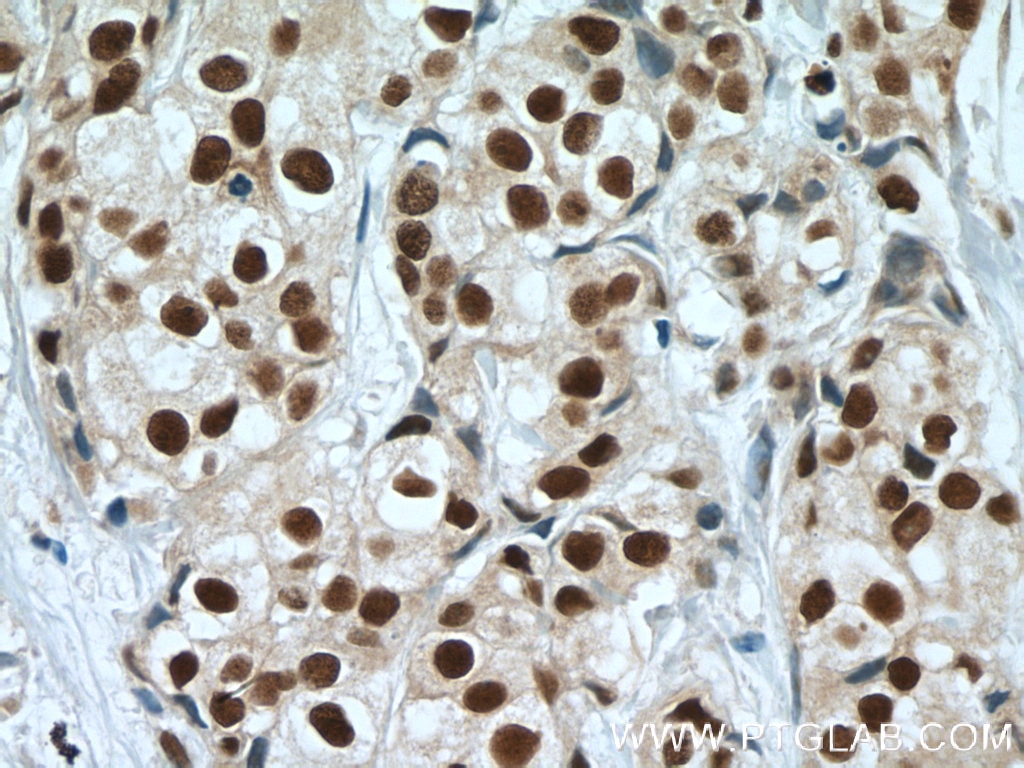Immunohistochemistry (IHC) staining of human breast cancer tissue using CstF-64 Polyclonal antibody (26825-1-AP)
