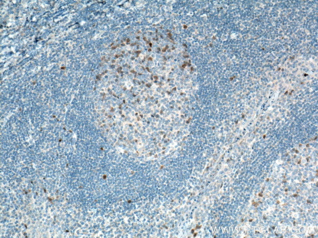 Immunohistochemistry (IHC) staining of human tonsillitis tissue using Cyclin A2 Monoclonal antibody (66391-1-Ig)