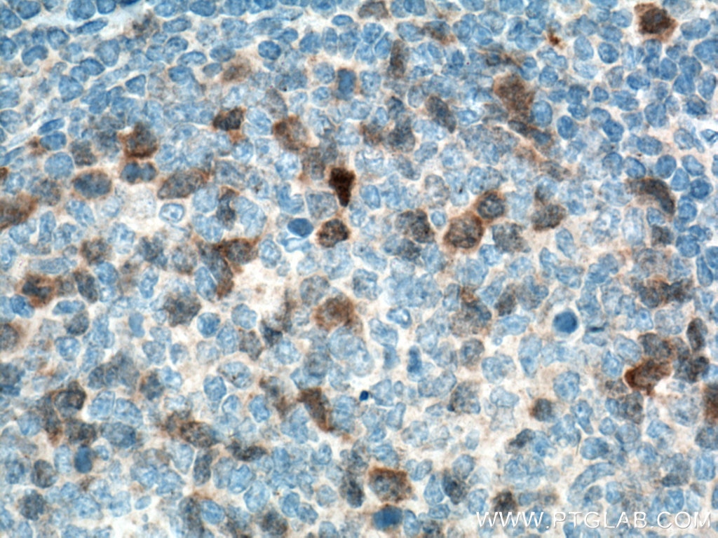 Immunohistochemistry (IHC) staining of human tonsillitis tissue using Cyclin A2 Monoclonal antibody (66391-1-Ig)