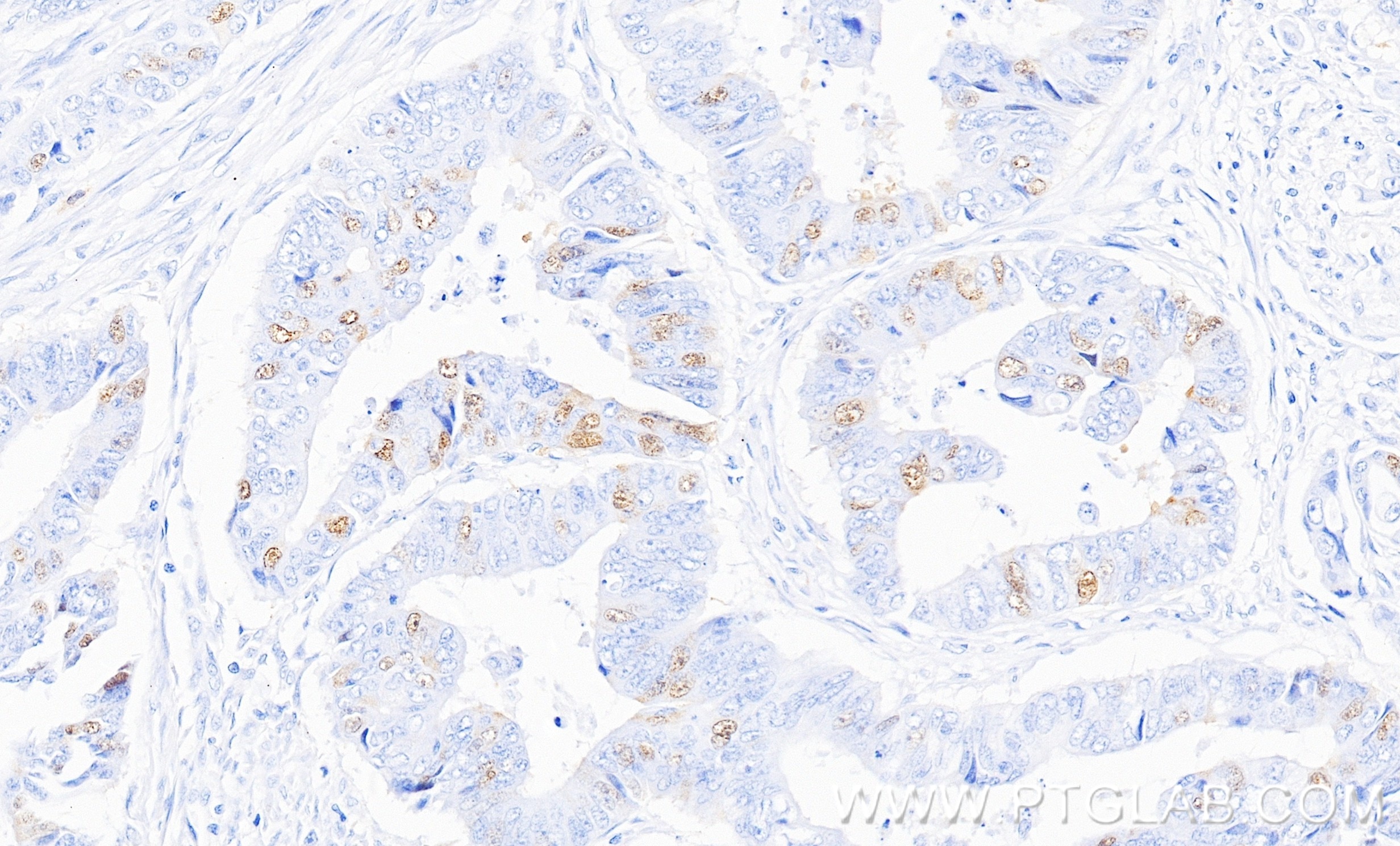 IHC staining of human colon cancer using 82148-1-RR Immunohistochemistry (IHC) staining of human colon cancer tissue using Cyclin A2 Recombinant monoclonal antibody (82148-1-RR)