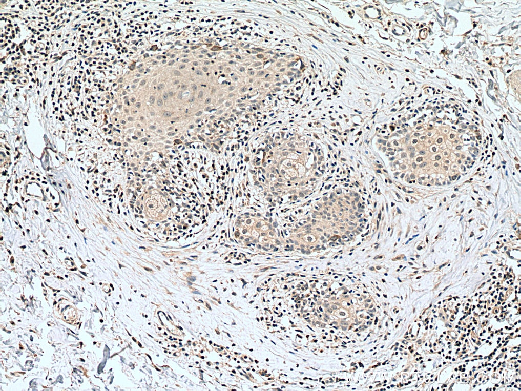 Immunohistochemistry (IHC) staining of human skin cancer tissue using Cyclin B1 Polyclonal antibody (28603-1-AP)