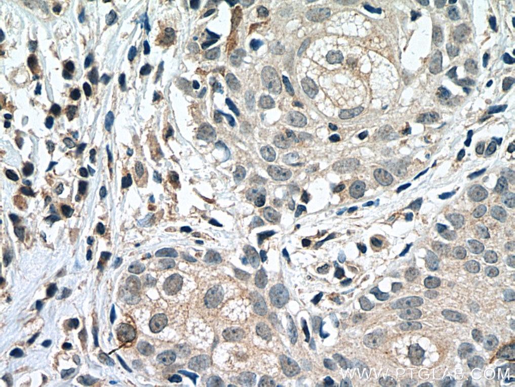 Immunohistochemistry (IHC) staining of human skin cancer tissue using Cyclin B1 Polyclonal antibody (28603-1-AP)