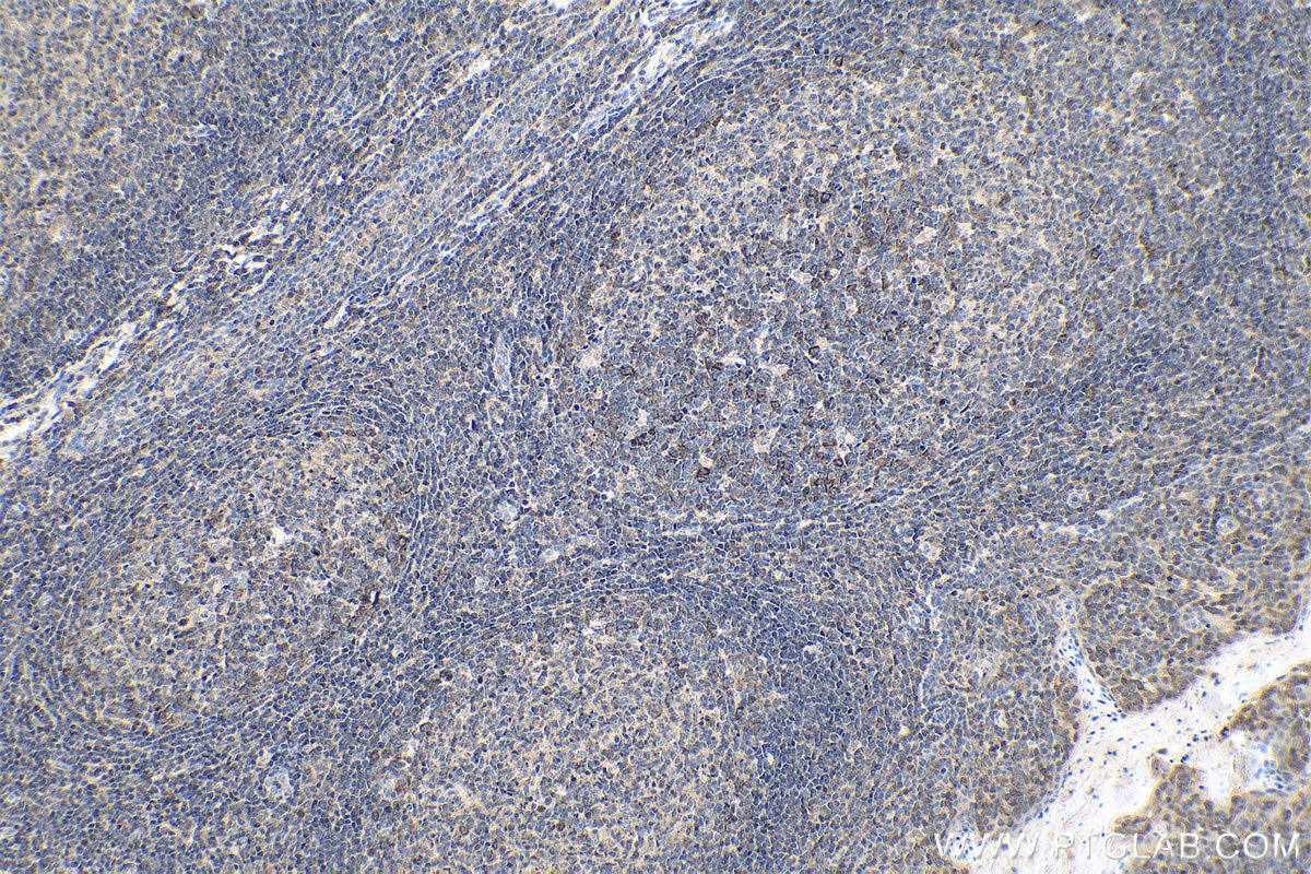 Immunohistochemistry (IHC) staining of human tonsillitis tissue using Cyclin B1 Polyclonal antibody (28603-1-AP)