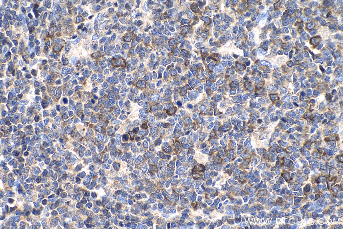 Immunohistochemistry (IHC) staining of human tonsillitis tissue using Cyclin B1 Polyclonal antibody (28603-1-AP)