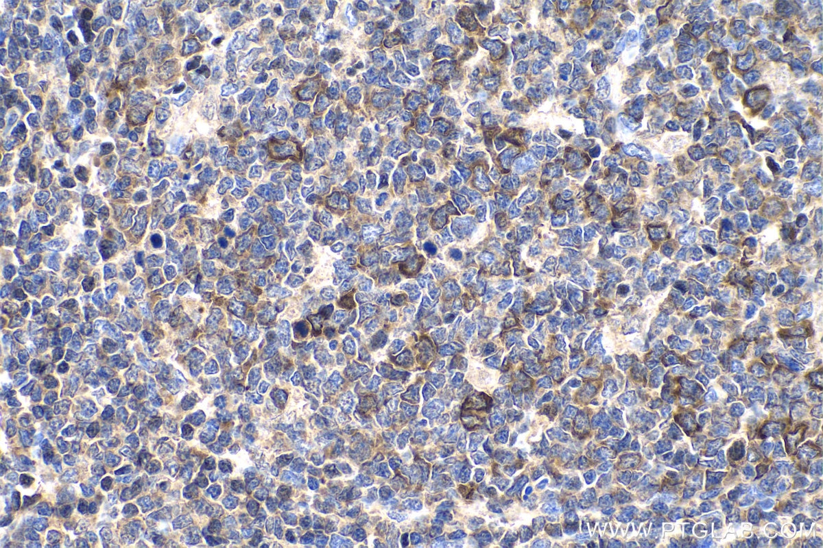 IHC staining of human tonsillitis using 28603-1-AP