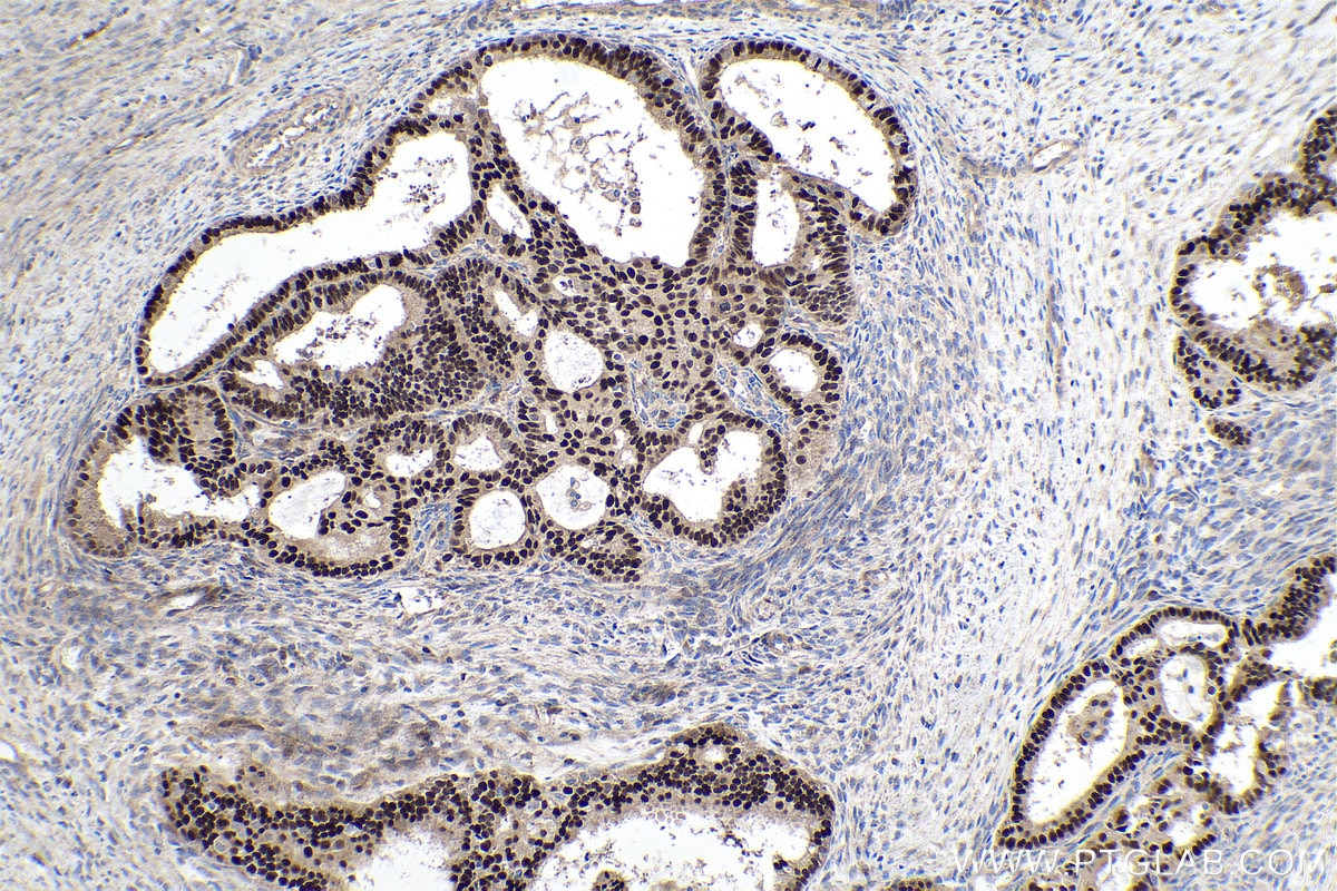 Immunohistochemistry (IHC) staining of human ovary tumor tissue using Cyclin D1 Polyclonal antibody (26939-1-AP)