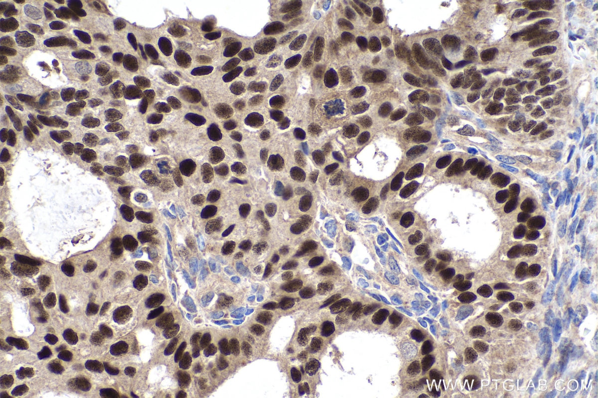 Immunohistochemistry (IHC) staining of human ovary tumor tissue using Cyclin D1 Polyclonal antibody (26939-1-AP)