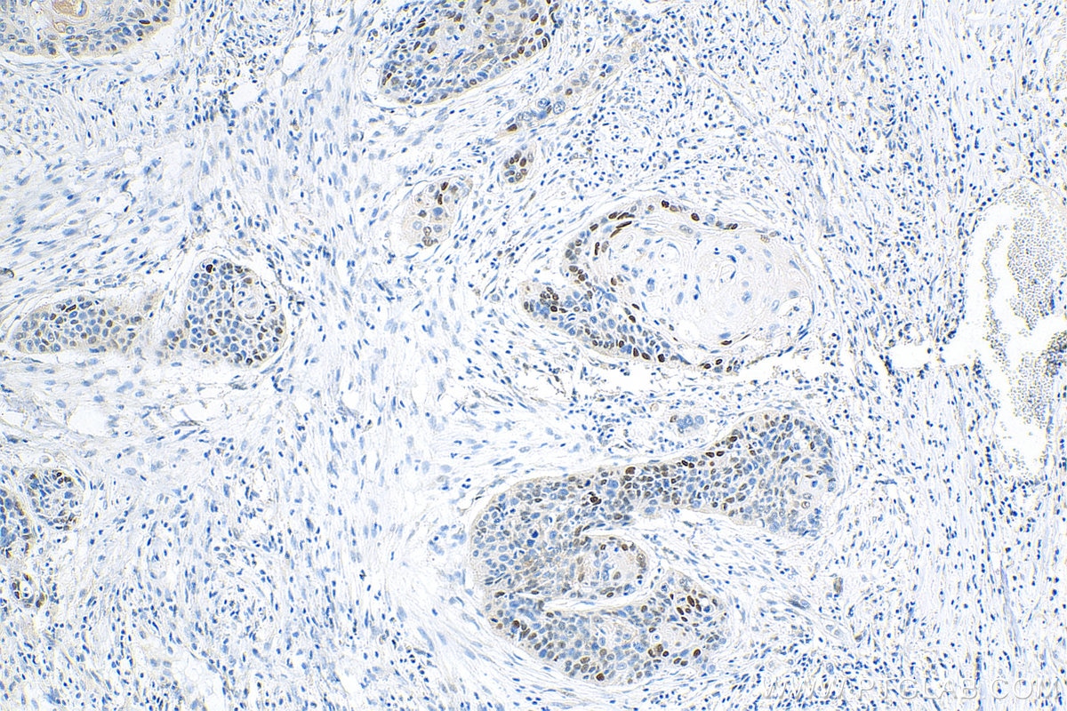 Immunohistochemistry (IHC) staining of human oesophagus cancer tissue using Cyclin D1 Polyclonal antibody (26939-1-AP)