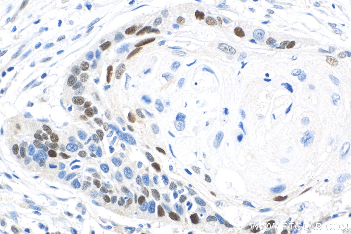 Immunohistochemistry (IHC) staining of human oesophagus cancer tissue using Cyclin D1 Polyclonal antibody (26939-1-AP)