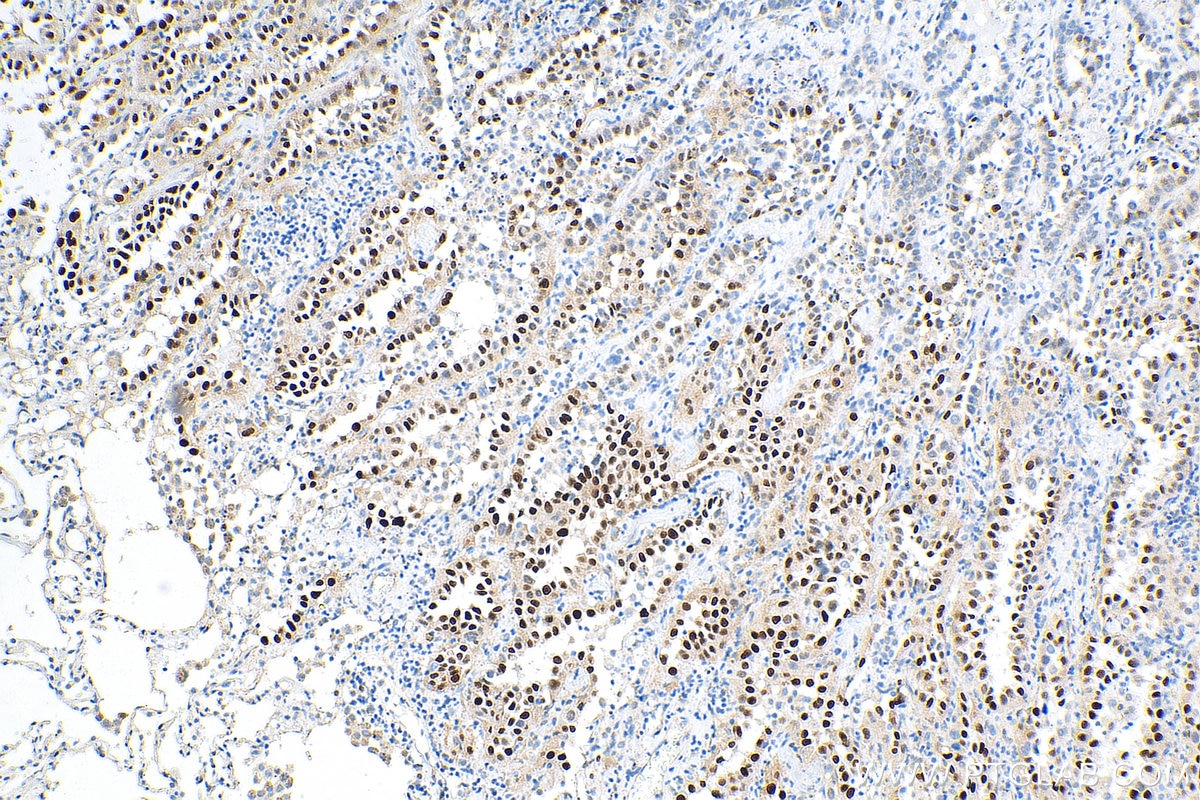 Immunohistochemistry (IHC) staining of human lung cancer tissue using Cyclin D1 Polyclonal antibody (26939-1-AP)