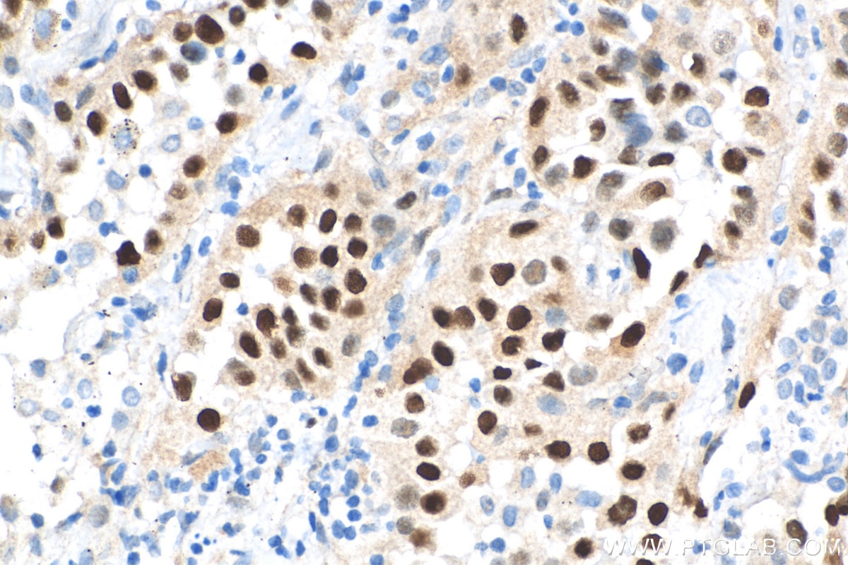 IHC staining of human lung cancer using 26939-1-AP