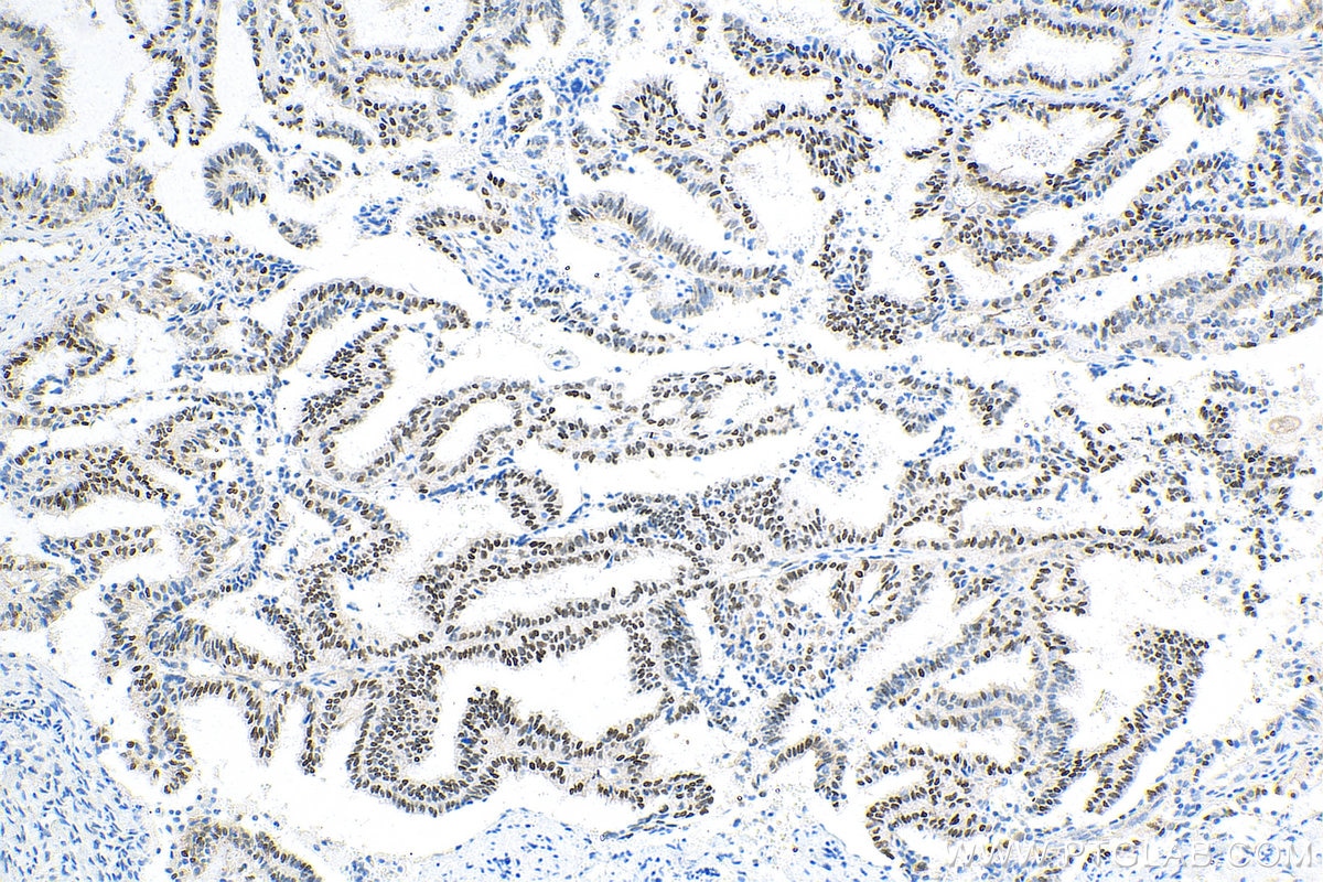 Immunohistochemistry (IHC) staining of human ovary tumor tissue using Cyclin D1 Polyclonal antibody (26939-1-AP)