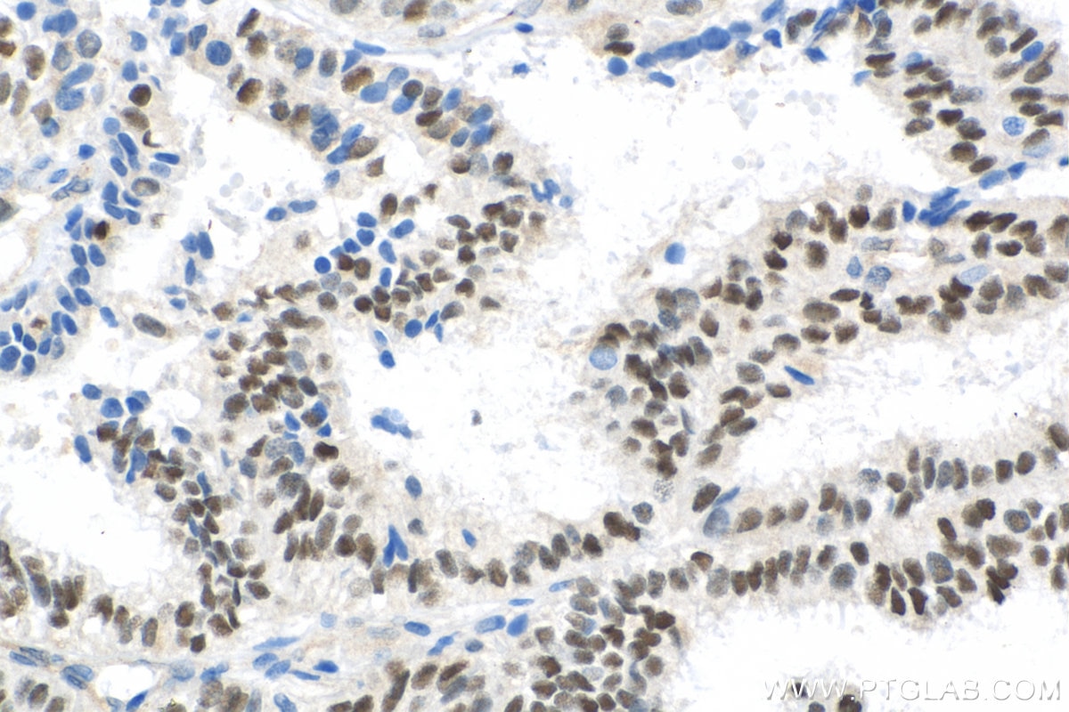 Immunohistochemistry (IHC) staining of human ovary tumor tissue using Cyclin D1 Polyclonal antibody (26939-1-AP)