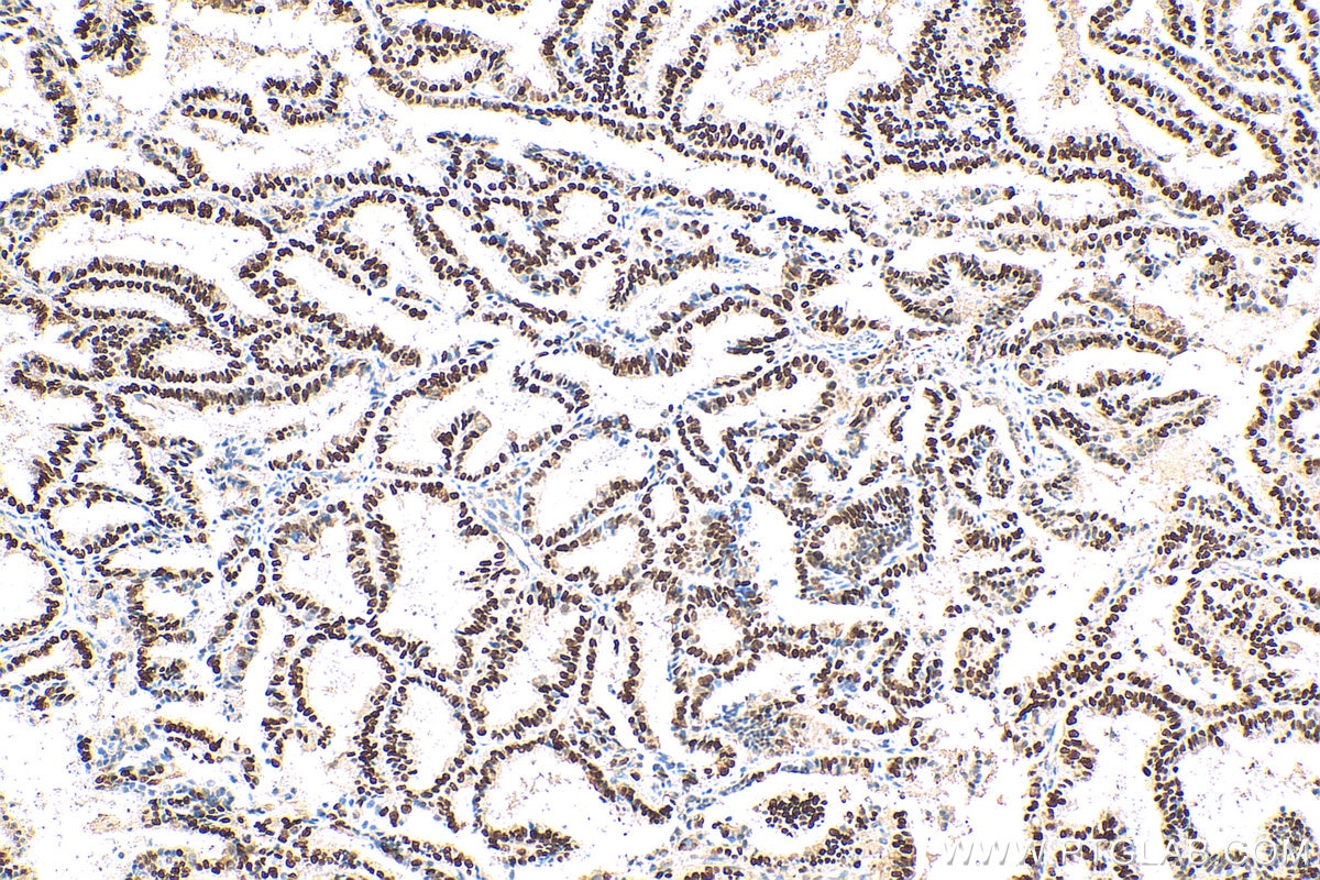 Immunohistochemistry (IHC) staining of human ovary tumor tissue using Cyclin D1 Polyclonal antibody (26939-1-AP)