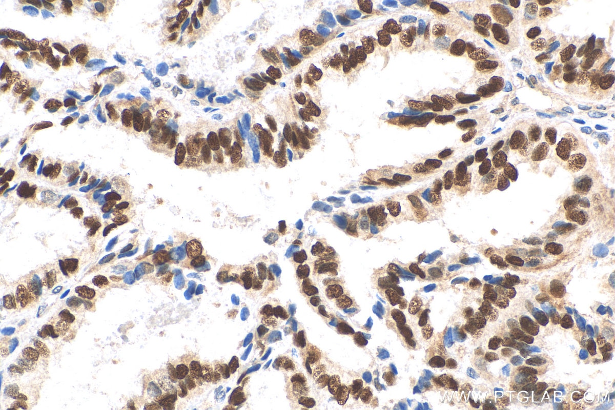 Immunohistochemistry (IHC) staining of human ovary tumor tissue using Cyclin D1 Polyclonal antibody (26939-1-AP)