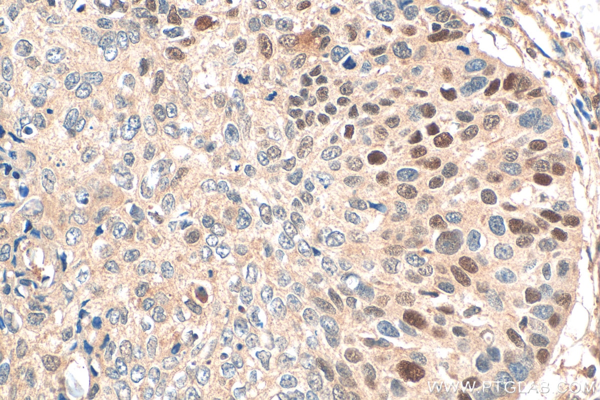 Immunohistochemistry (IHC) staining of human oesophagus cancer tissue using Cyclin D1 Recombinant antibody (82681-1-RR)