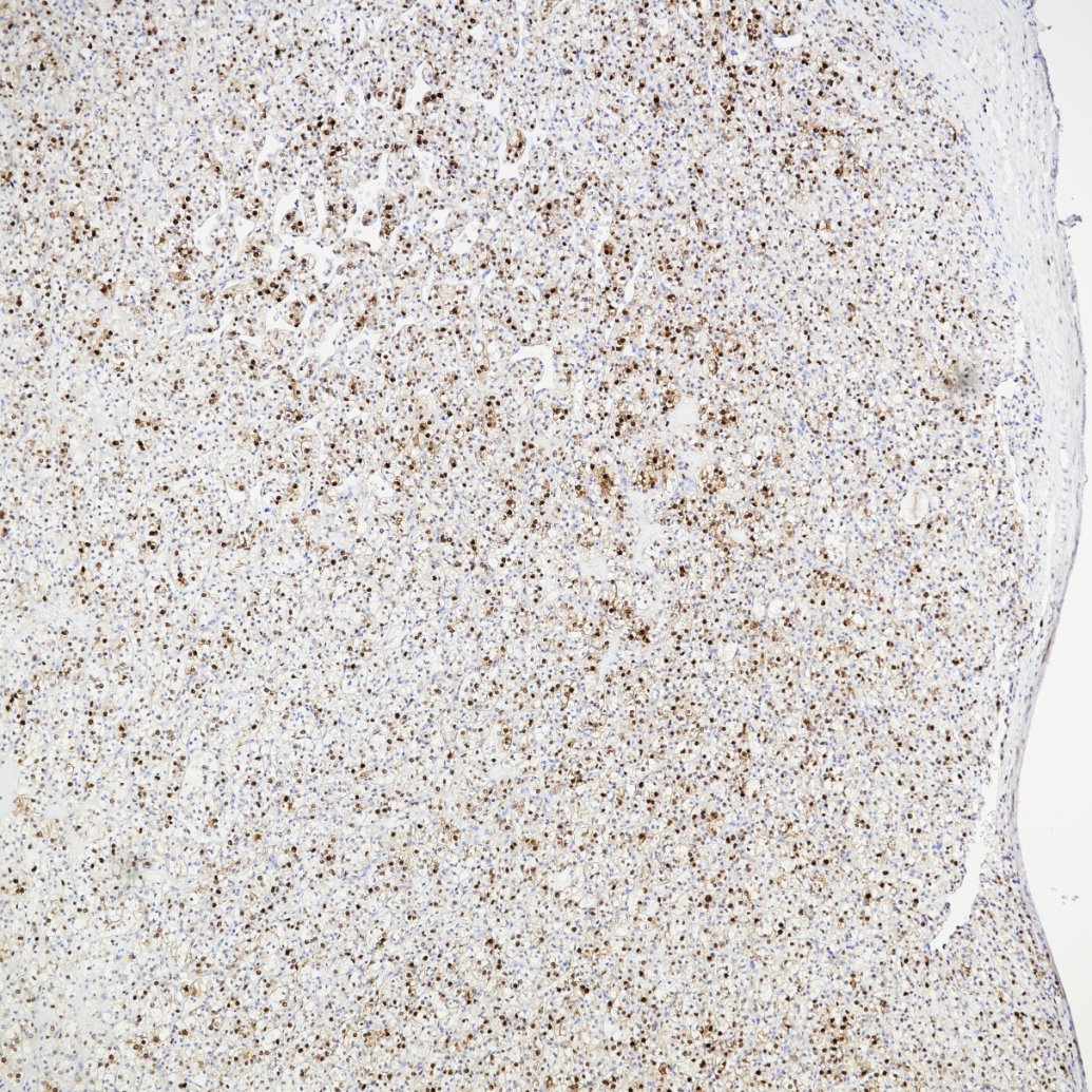 Immunohistochemistry (IHC) staining of human renal cell carcinoma tissue using Cyclin D1 Recombinant monoclonal antibody (82681-1-RR)
