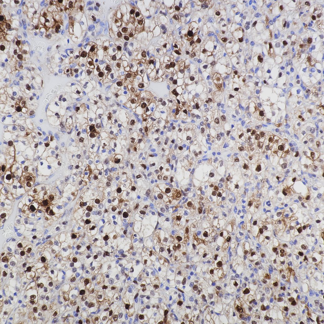 Immunohistochemistry (IHC) staining of human renal cell carcinoma tissue using Cyclin D1 Recombinant monoclonal antibody (82681-1-RR)