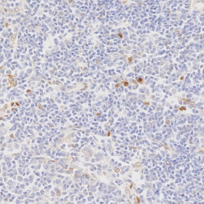 IHC staining of human lymphoma using 82681-1-RR Immunohistochemistry (IHC) staining of human lymphoma tissue using Cyclin D1 Recombinant monoclonal antibody (82681-1-RR)