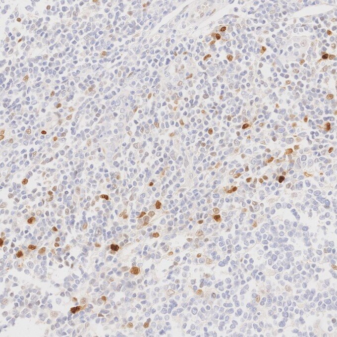 IHC staining of human lymphoma using 82681-1-RR Immunohistochemistry (IHC) staining of human lymphoma tissue using Cyclin D1 Recombinant monoclonal antibody (82681-1-RR)