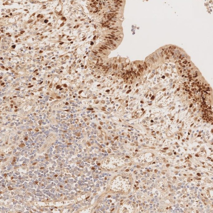 IHC staining of human lymphoma using 82681-1-RR Immunohistochemistry (IHC) staining of human lymphoma tissue using Cyclin D1 Recombinant monoclonal antibody (82681-1-RR)