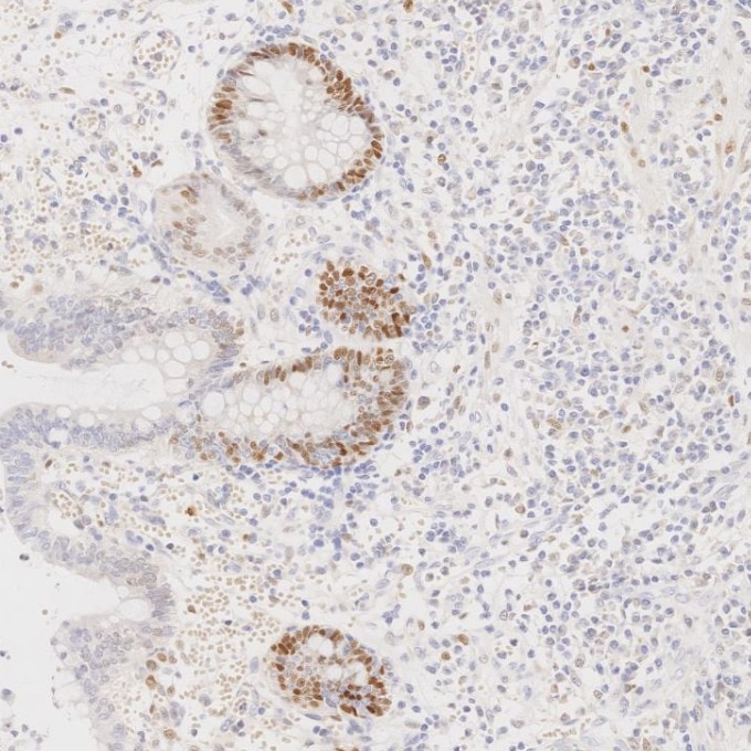 IHC staining of human lymphoma using 82681-1-RR Immunohistochemistry (IHC) staining of human lymphoma tissue using Cyclin D1 Recombinant monoclonal antibody (82681-1-RR)