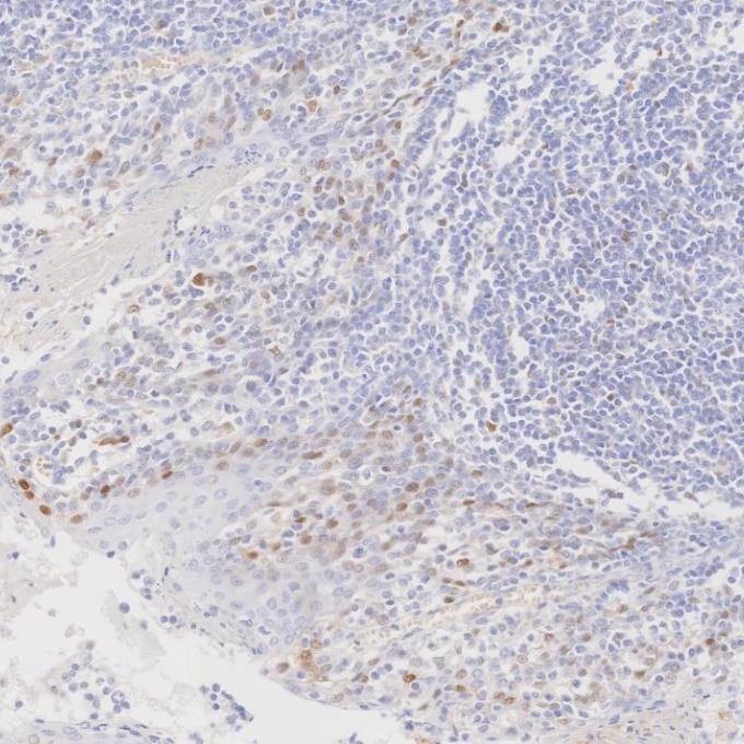 IHC staining of human tonsillitis using 82681-1-RR Immunohistochemistry (IHC) staining of human tonsillitis tissue using Cyclin D1 Recombinant monoclonal antibody (82681-1-RR)
