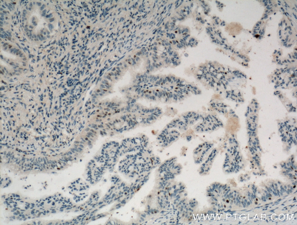 Immunohistochemistry (IHC) staining of human pancreas cancer tissue using Cyclin D3 Monoclonal antibody (66357-1-Ig)