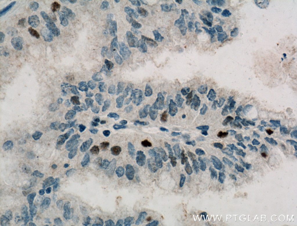 Immunohistochemistry (IHC) staining of human pancreas cancer tissue using Cyclin D3 Monoclonal antibody (66357-1-Ig)