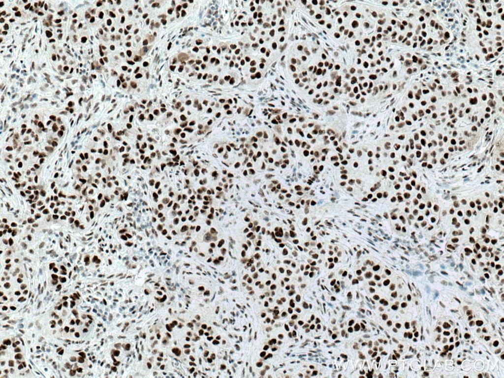 Immunohistochemistry (IHC) staining of human breast cancer tissue using Cyclin H Monoclonal antibody (67065-1-Ig)