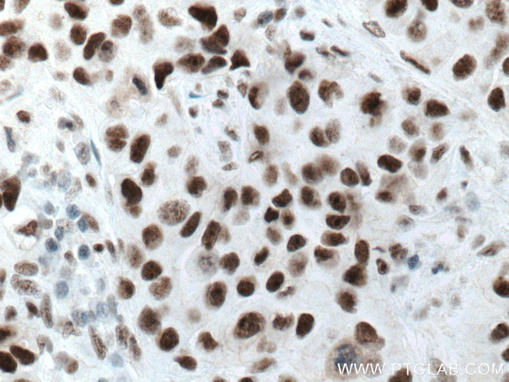 Immunohistochemistry (IHC) staining of human breast cancer tissue using Cyclin H Monoclonal antibody (67065-1-Ig)