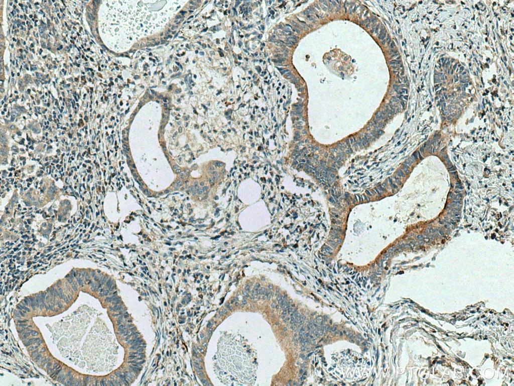 Immunohistochemistry (IHC) staining of human stomach cancer tissue using Cystatin S Polyclonal antibody (26979-1-AP)
