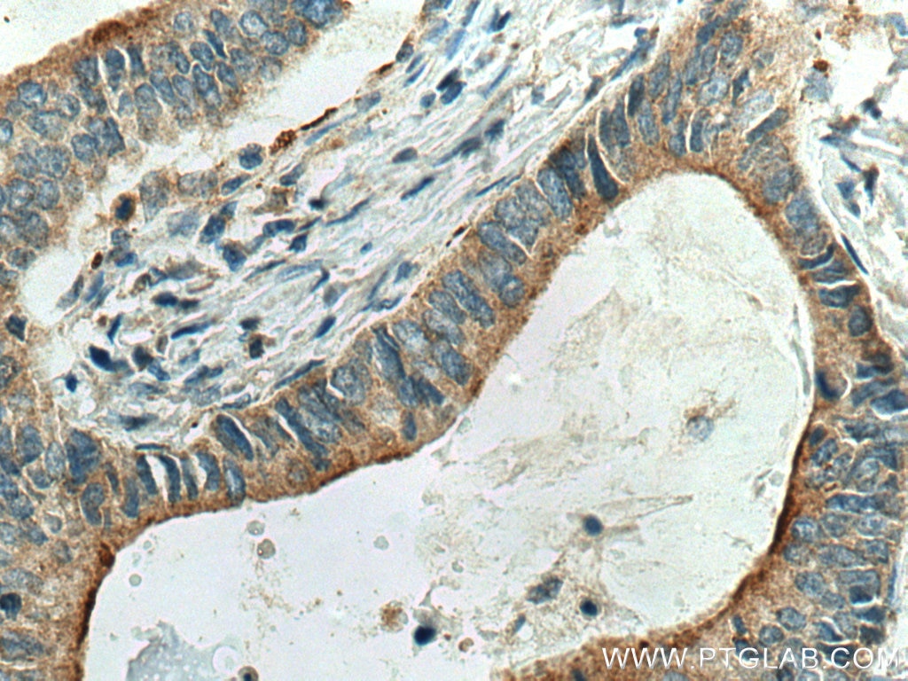 Immunohistochemistry (IHC) staining of human stomach cancer tissue using Cystatin S Polyclonal antibody (26979-1-AP)