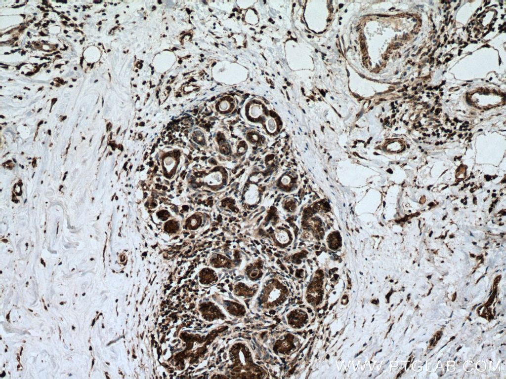 IHC staining of human breast cancer using 66264-1-Ig