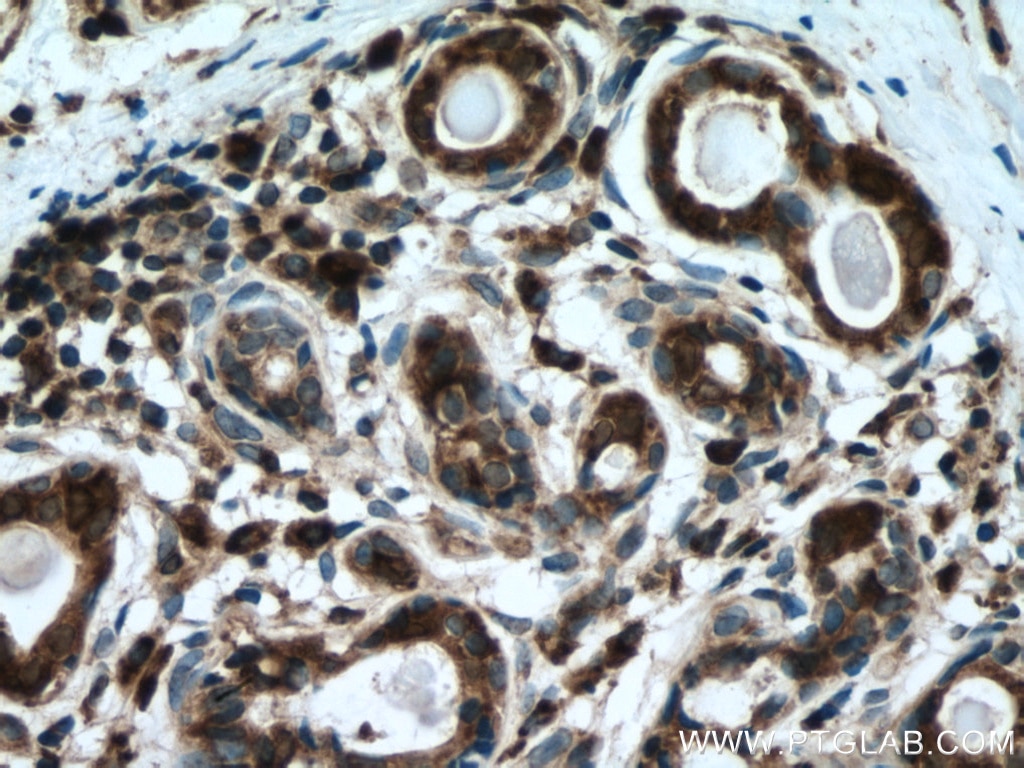 Immunohistochemistry (IHC) staining of human breast cancer tissue using Cytochrome c Monoclonal antibody (66264-1-Ig)