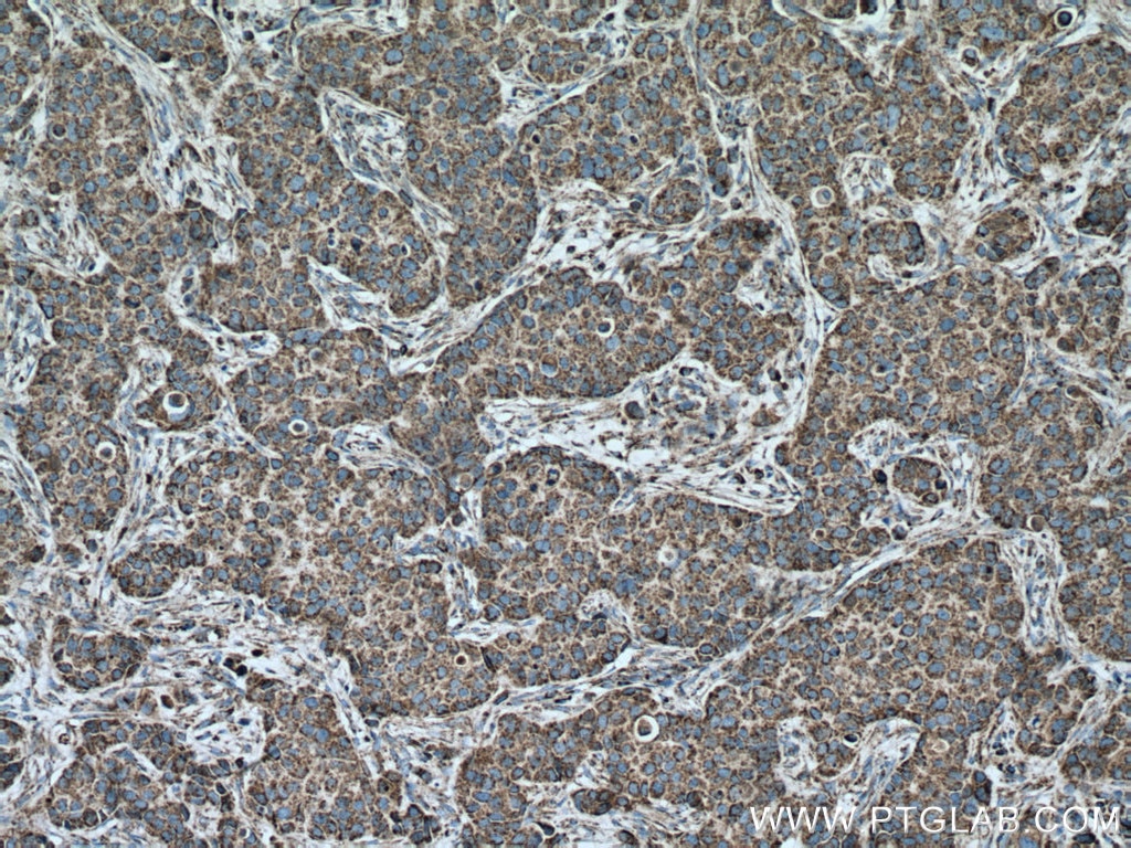 Immunohistochemistry (IHC) staining of human breast cancer tissue using Cytochrome c Monoclonal antibody (66264-1-Ig)