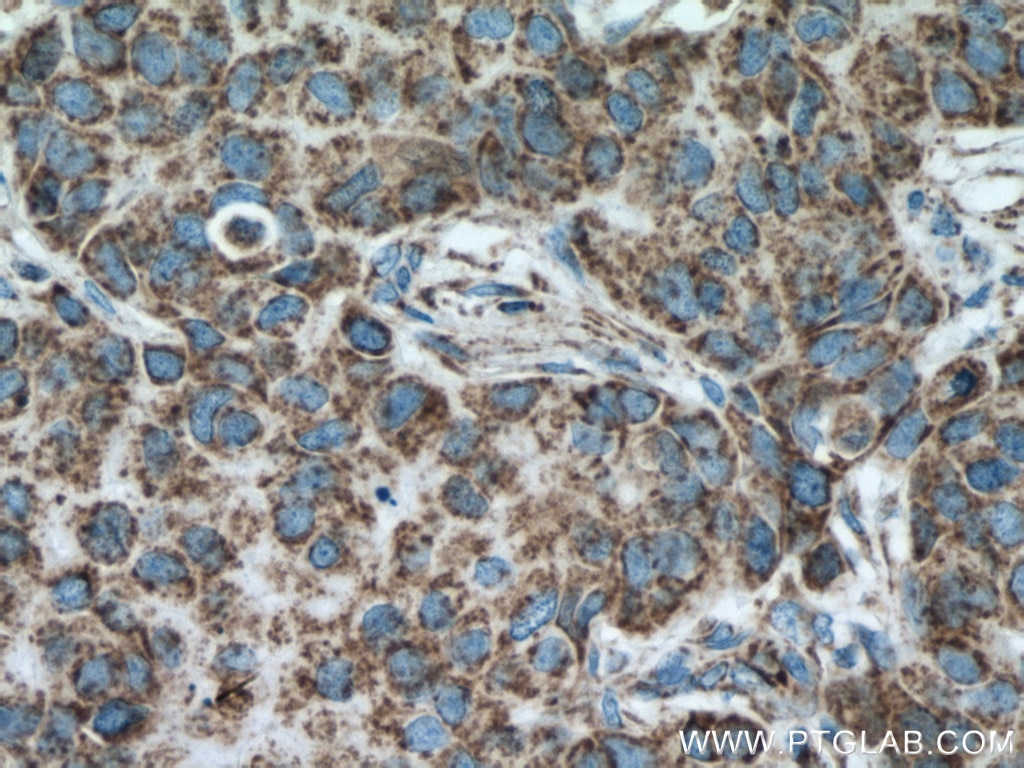 Immunohistochemistry (IHC) staining of human breast cancer tissue using Cytochrome c Monoclonal antibody (66264-1-Ig)