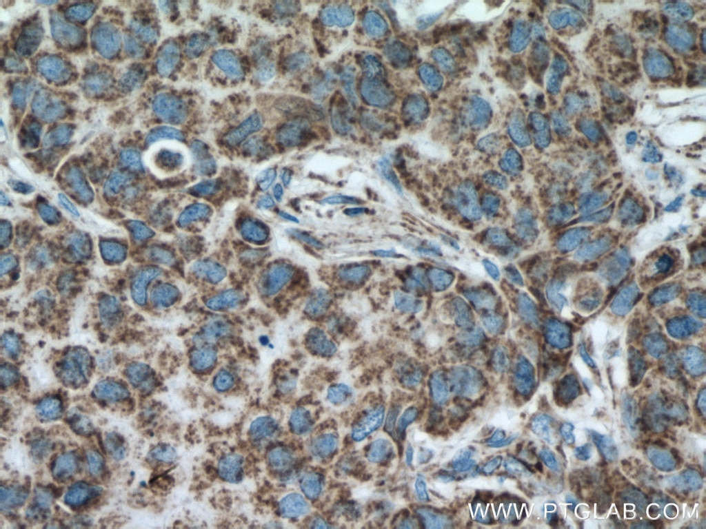 IHC staining of human breast cancer using 66264-1-Ig